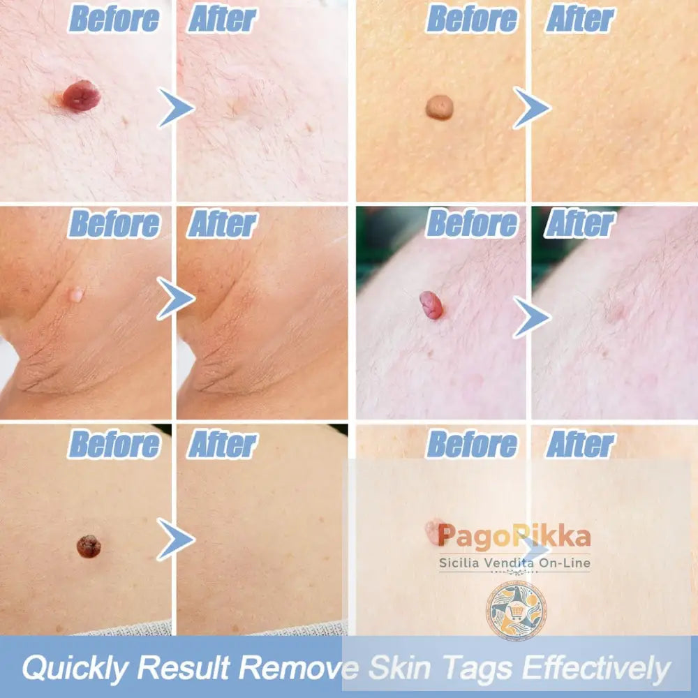 Rimozione di etichette cutanee Rimozione dell’acne Rimozione delle verruche Rimozione di etichette cutanee Rimozione